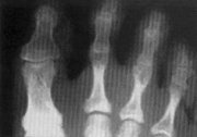 fracture toe