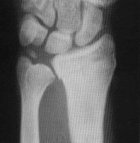 lower radius and ulna