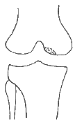 osteochondritis lesion